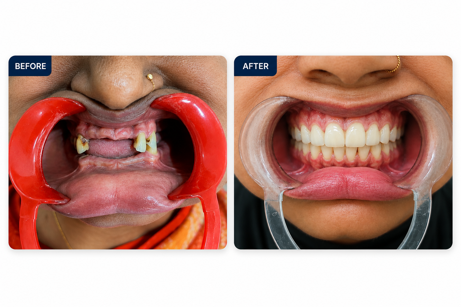 Full-mouth rehabilitation