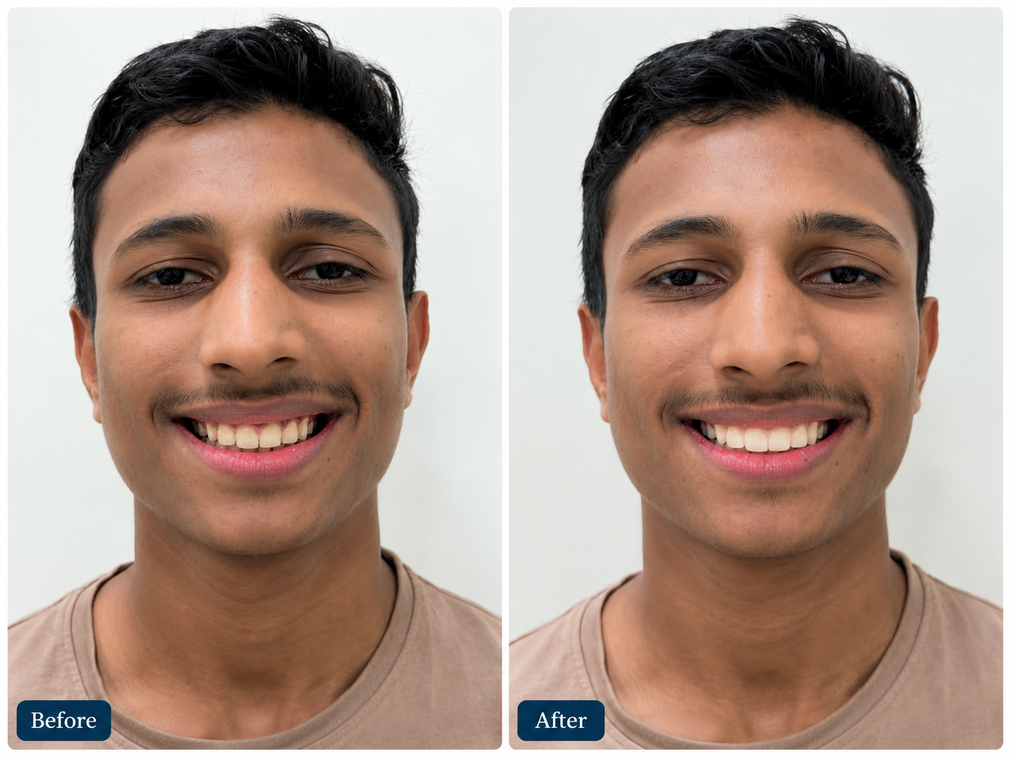 Smile makeover